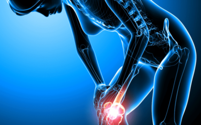 Arthritis of the Knee: How to Manage