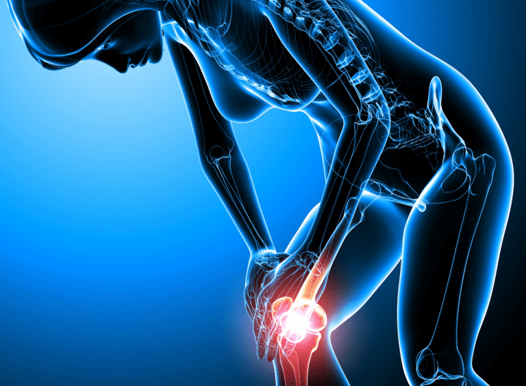 Arthritis of the Knee: How to Manage