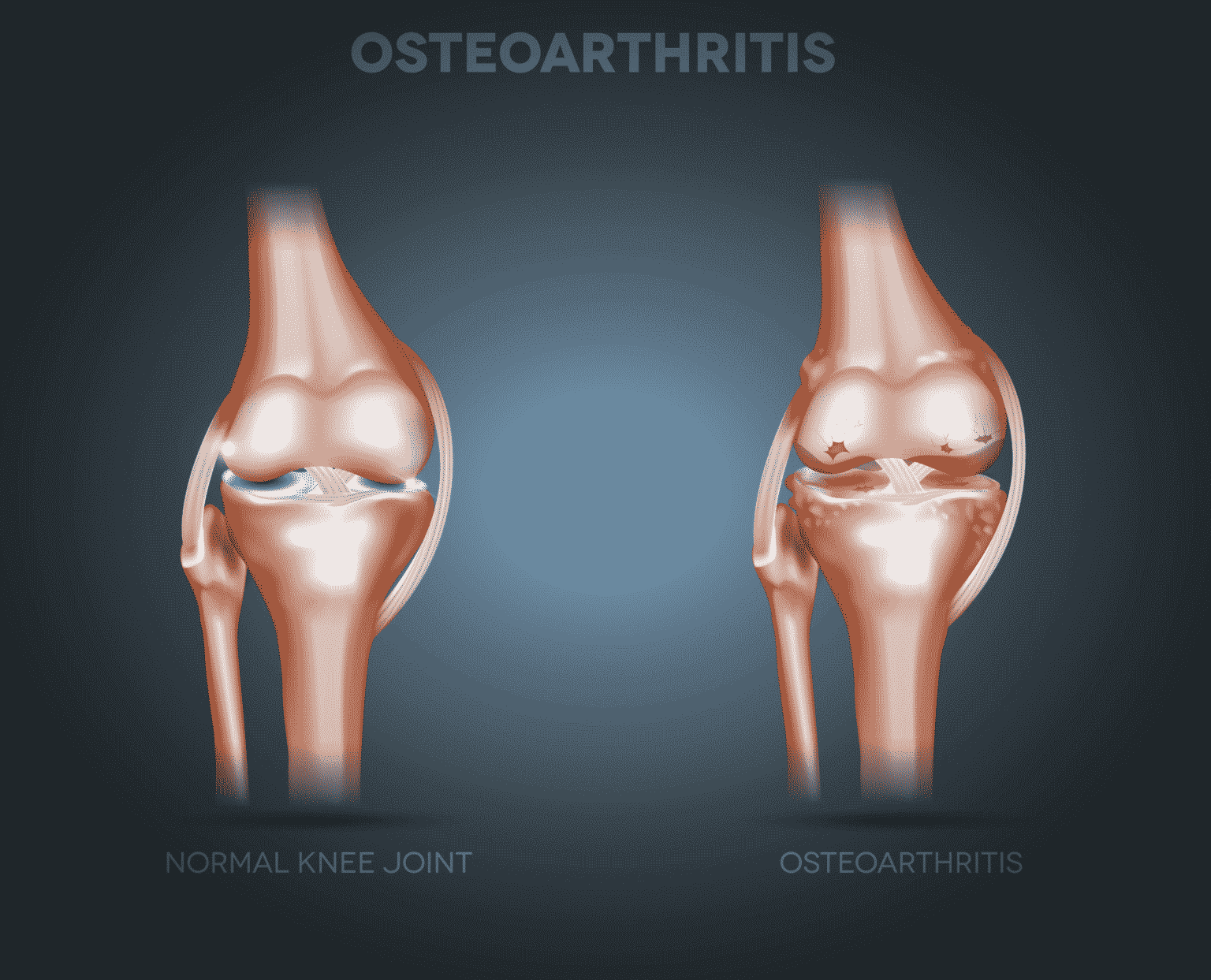 osteoarthritis in knee